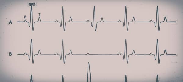 Electrocardiogram (ECG)