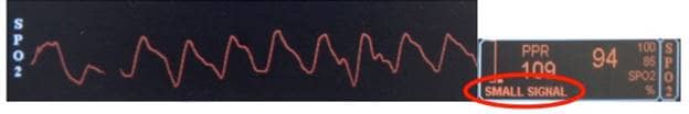 photoplethysmographic curve