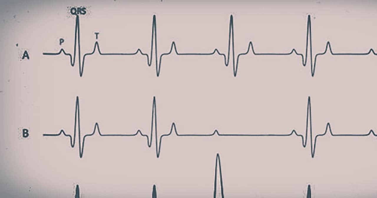 Electrocardiogram