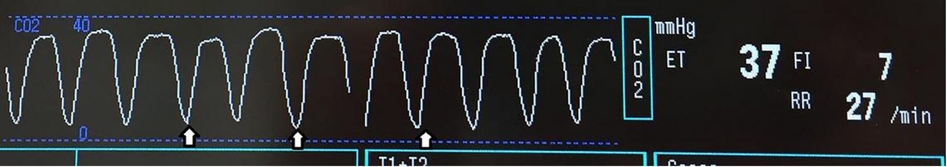 Capnograph Waves