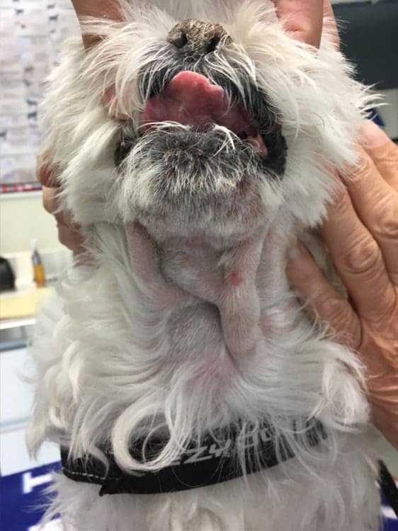 Methicillin resistant bacterial dermatitis after Laser