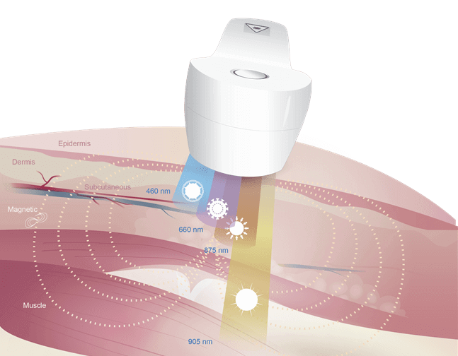 Cascade de lumière bleue - Thérapie au laser