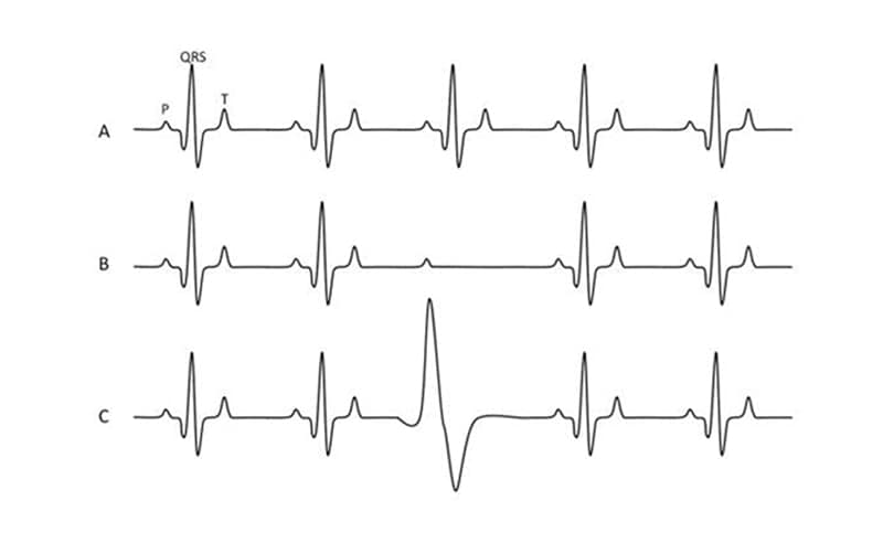 Traces ECG